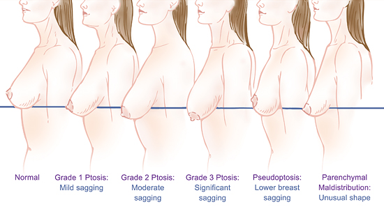 Breast Review After Surgery - BRAS - 💓 Breasts come in many different  shapes and sizes, and ptosis or sagging of the breasts is a common  condition affecting women, particularly those who