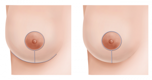 Mastopexy — Perfect Breasts San Jose Vertical Incision