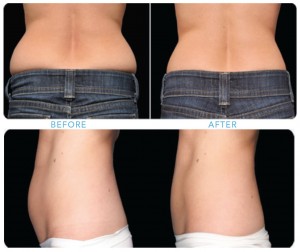CoolSculpting: Reshape Your Body without Surgery - Bachelor, Eric