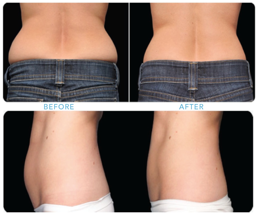 CoolSculpting Non-Surgical Body Contouring Work?