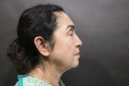 Facelift Before & After Patient #7486