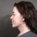 Facelift Before & After Patient #7487