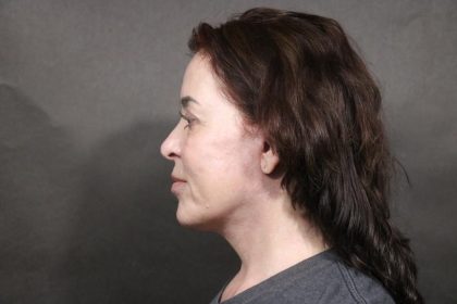 Facelift Before & After Patient #7487