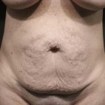 Abdominoplasty Before & After Patient #7461