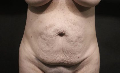 Abdominoplasty Before & After Patient #7461