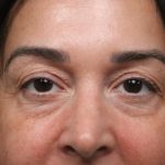 Lower Blepharoplasty Before & After Patient #7482
