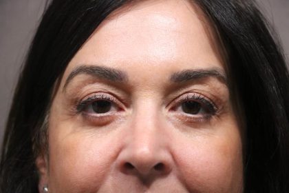 Lower Blepharoplasty Before & After Patient #7482