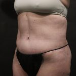 Abdominoplasty Before & After Patient #7469