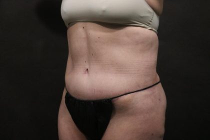 Abdominoplasty Before & After Patient #7469